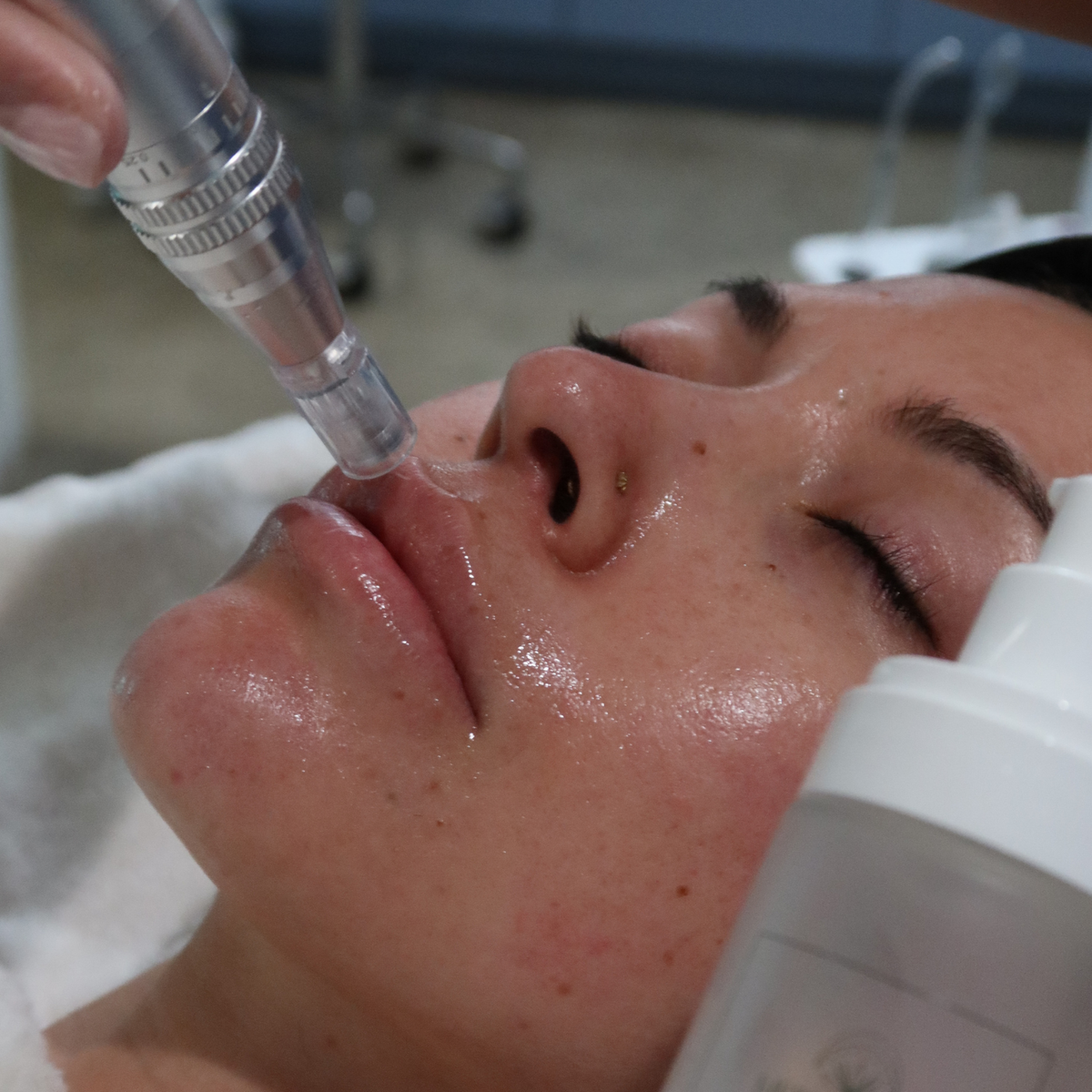 Collagen Induction Therapy (CIT) / Micro-Needling + Nano-Infusion